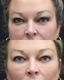 PRP Undereyes B&A Delta March 2026