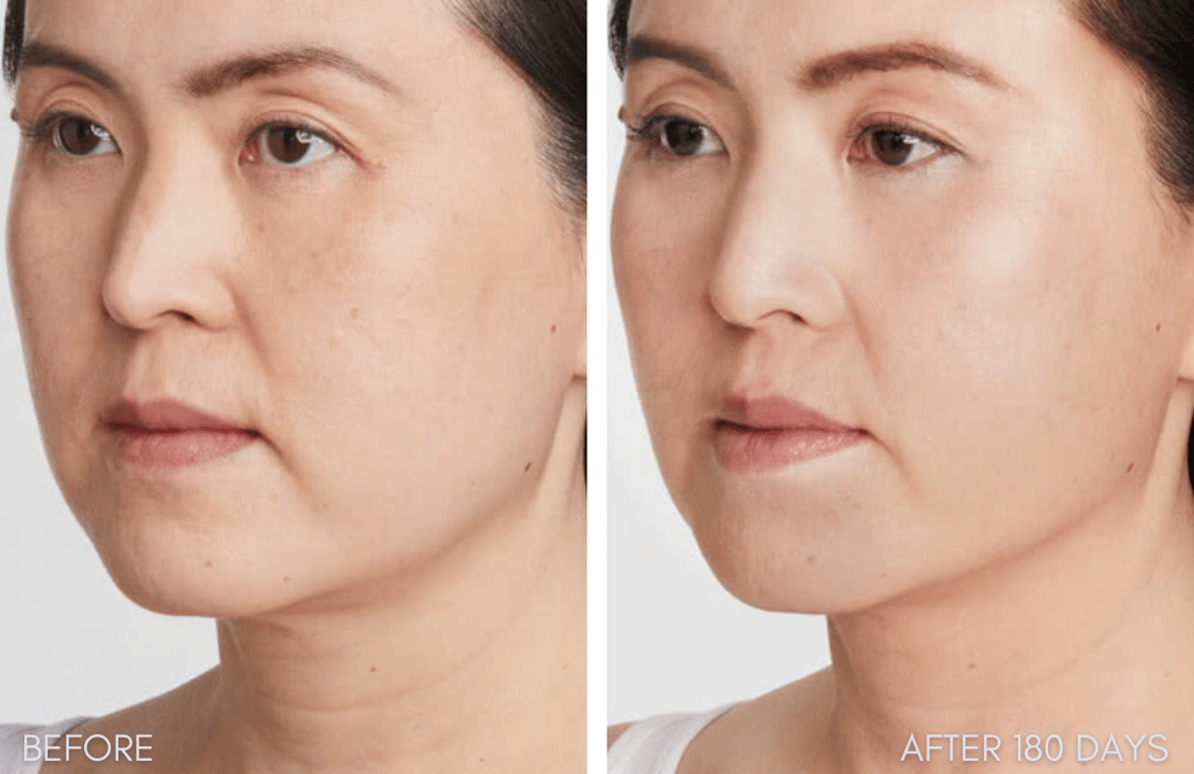 Ultherapy before and after