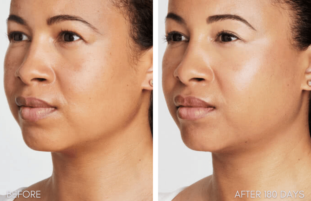 Ultherapy before and after