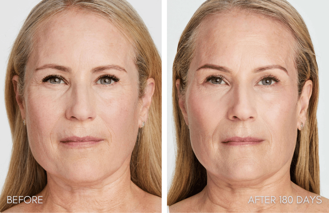 Full face Ultherapy before and after
