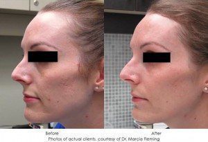Acne-Scar-7-300x205-1-300x205