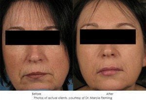 Photorejuvenation-img11