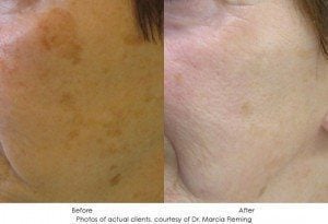 Photorejuvenation-img12