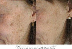 Photorejuvenation-img3