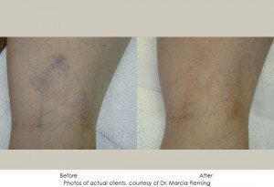 Sclerotherapy-img1
