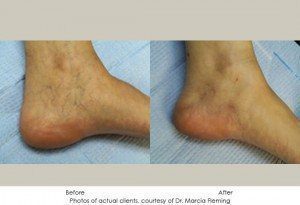 Sclerotherapy-img2