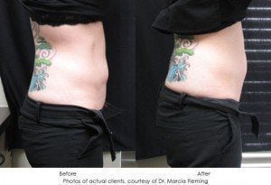 coolsculpting-img1