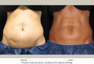 coolsculpting-img10