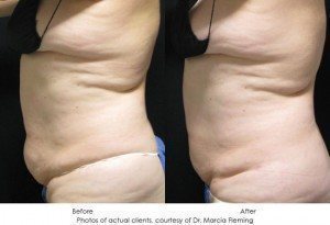 coolsculpting-img12