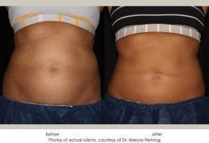 coolsculpting-img13