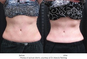 coolsculpting-img14