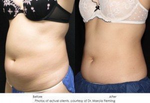 coolsculpting-img16