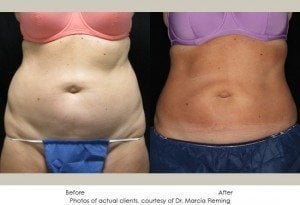 coolsculpting-img17