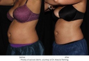 coolsculpting-img2