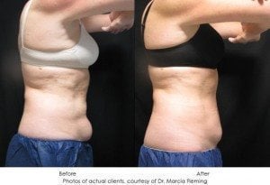 coolsculpting-img20