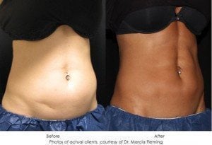 coolsculpting-img21