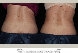 coolsculpting-img22