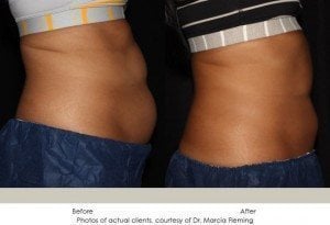 coolsculpting-img23