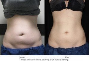 coolsculpting-img24