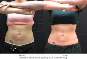 coolsculpting-img27