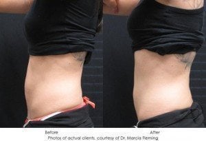 coolsculpting-img29