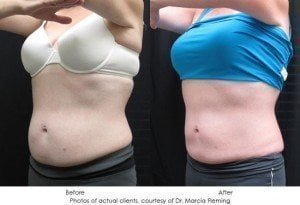 coolsculpting-img5