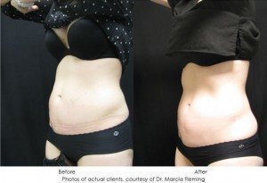 coolsculpting-img6