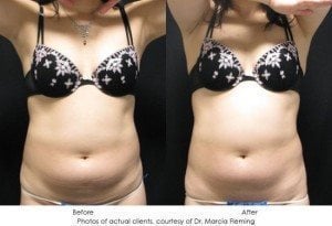 coolsculpting-img8