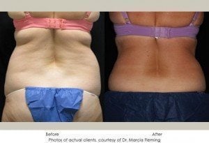 coolsculpting-img9