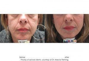 dermal-fillers-img1