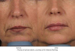 dermal-fillers-img12