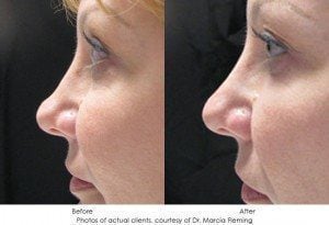 dermal-fillers-img15