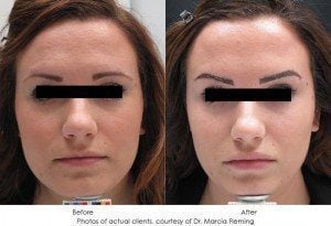 dermal-fillers-img19