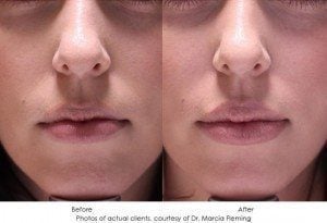 dermal-fillers-img2