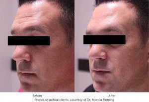 dermal-fillers-img20