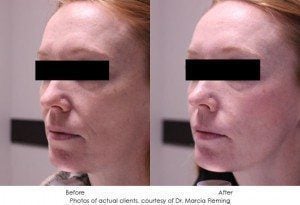 dermal-fillers-img24