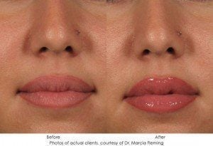 dermal-fillers-img5