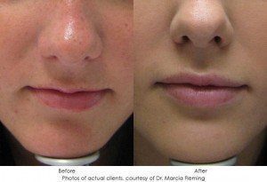 dermal-fillers-img6