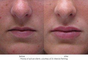 dermal-fillers-img7