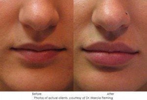 dermal-fillers-img9