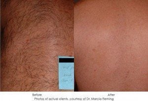 laser-hair-removal-img1